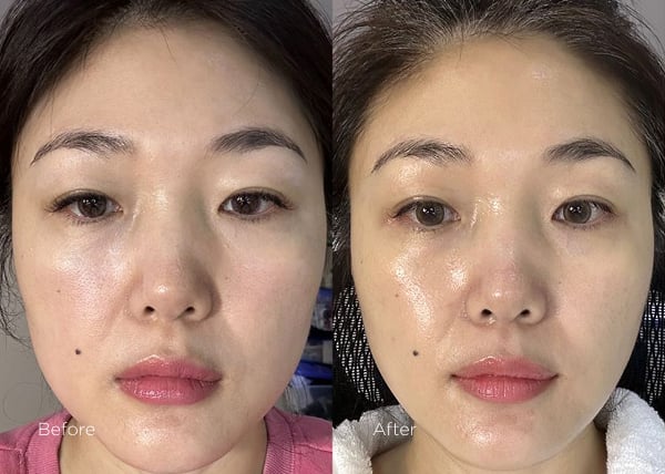 Titamium Lifting Mesotherapy BBL Hero ic4