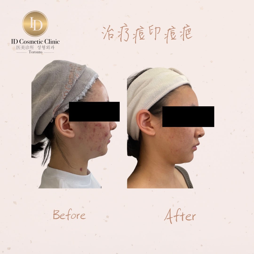 12.治疗痘疤痘印Consent