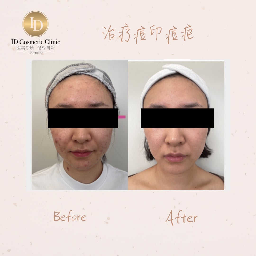 13.治疗痘疤痘印Consent 2