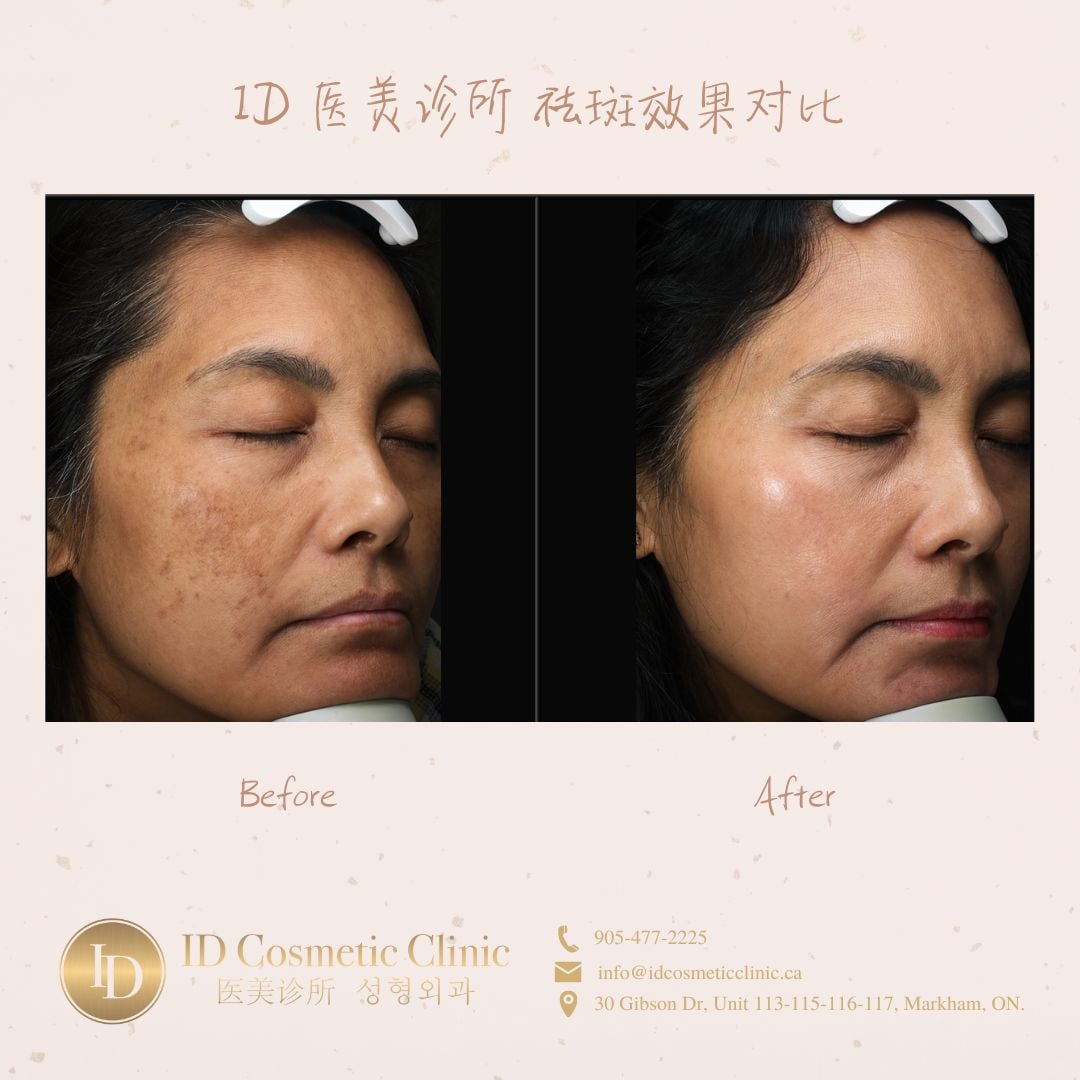 2.祛斑效果对比consent