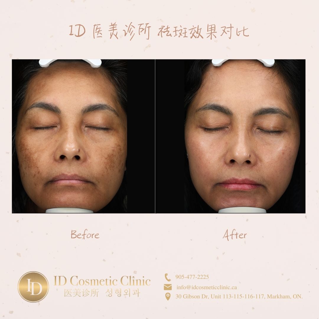 3.祛斑效果对比consent