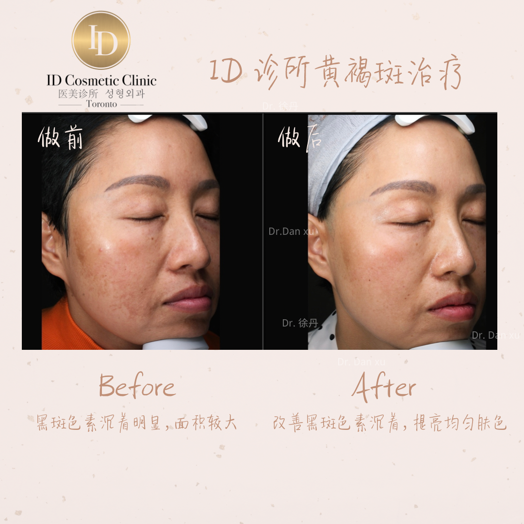 6. 黄褐斑治疗 1