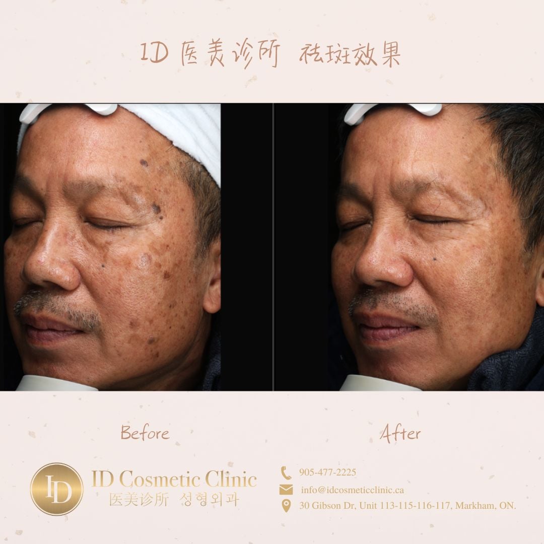 ID 医美诊所 祛斑效果 3