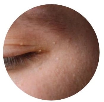 外用免疫促進劑脫疣