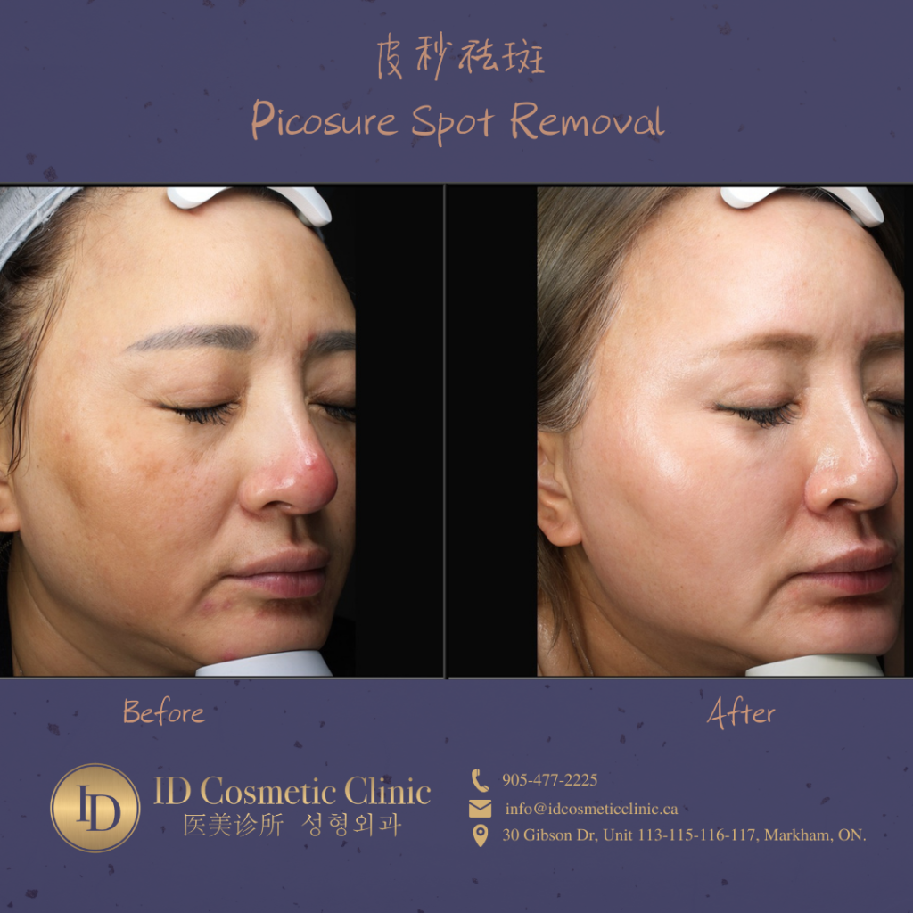 皮秒 祛斑 美白 ID PicoSure PicoSure Pro PicoWay Hyperpigmentation Removal​