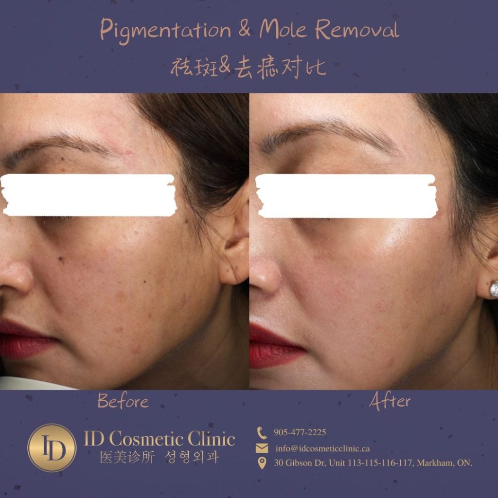 皮秒 祛斑 美白 ID PicoSure PicoSure Pro PicoWay Hyperpigmentation Removal​