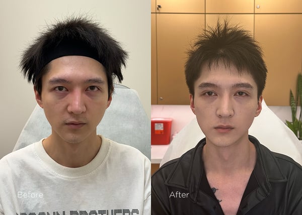 IPL photofacial before and after results for men showing improved skin appearance and texture