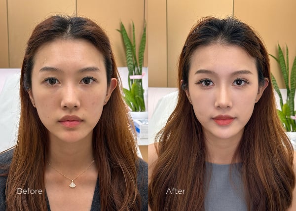 IPL photofacial before and after results showing enhanced skin clarity and tone