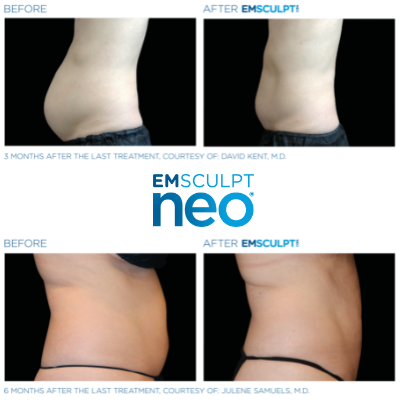 emsculpt neo before and after