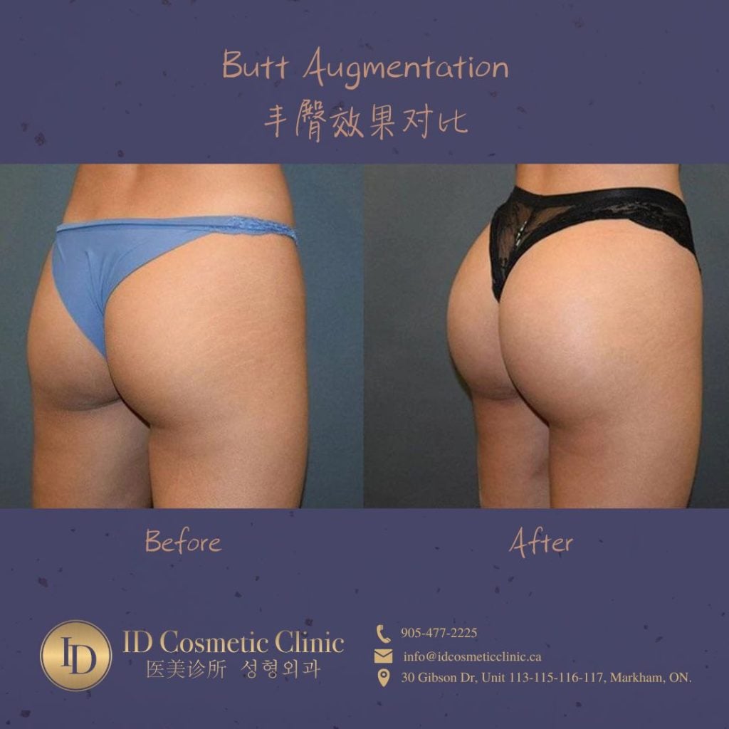 Butt Enhancement