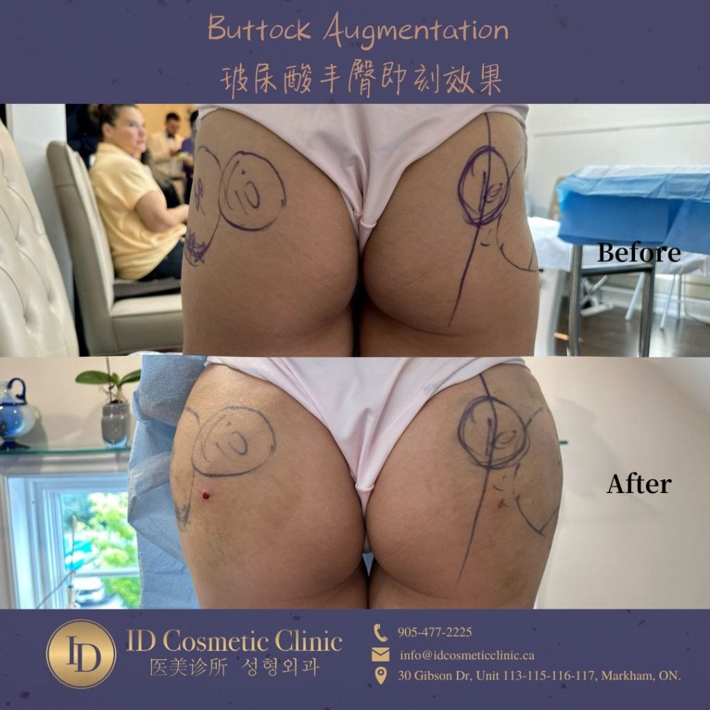Butt Enhancement Without Surgery