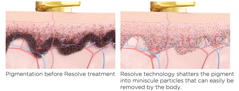 PICOWAY laser toronto