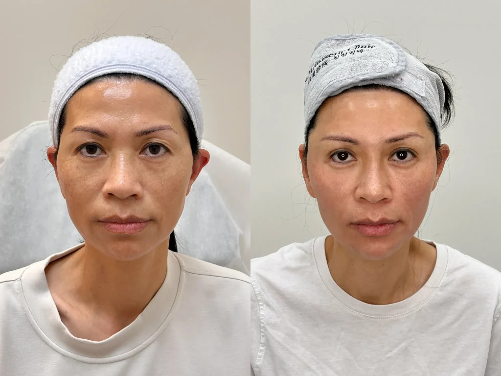 Toronto Cosmetics Clinic before and after - ID Cosmetic Clinic - Performed by Dr.Xu