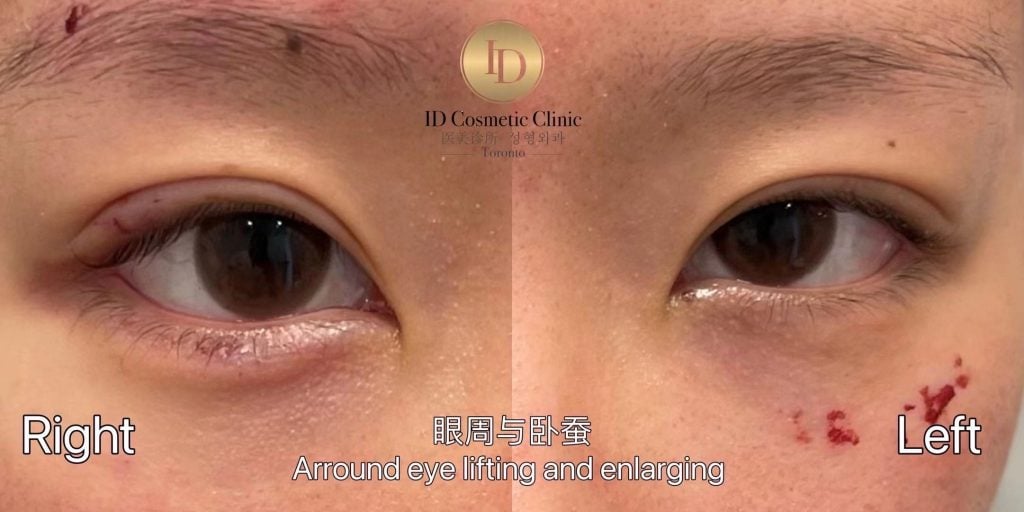 眼周塑型 卧蚕 眉骨塑型 多伦多 Eyebrow filler Tear worm injection eye enlargement