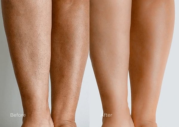 IPL photofacial before and after results showing smoother skin and improved clarity