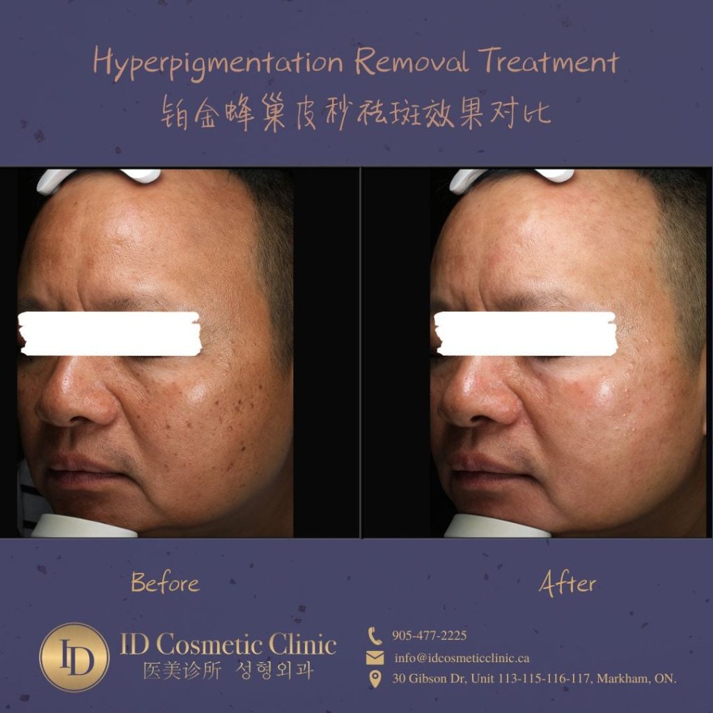 皮秒 祛斑 美白 ID PicoSure PicoSure Pro PicoWay Hyperpigmentation Removal​