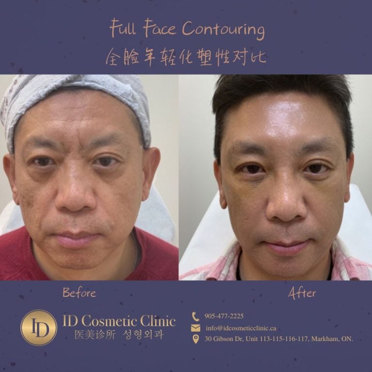 dermal filler toronto