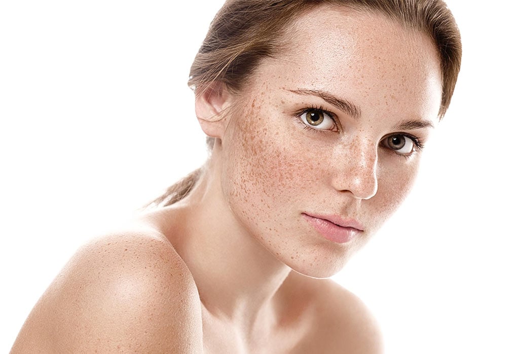 Melasma vs Hyperpigmentation