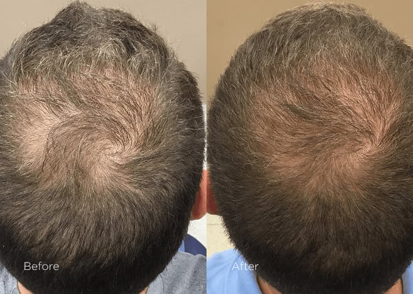 PRP scalp treatment before and after results showing improved hair density and growth