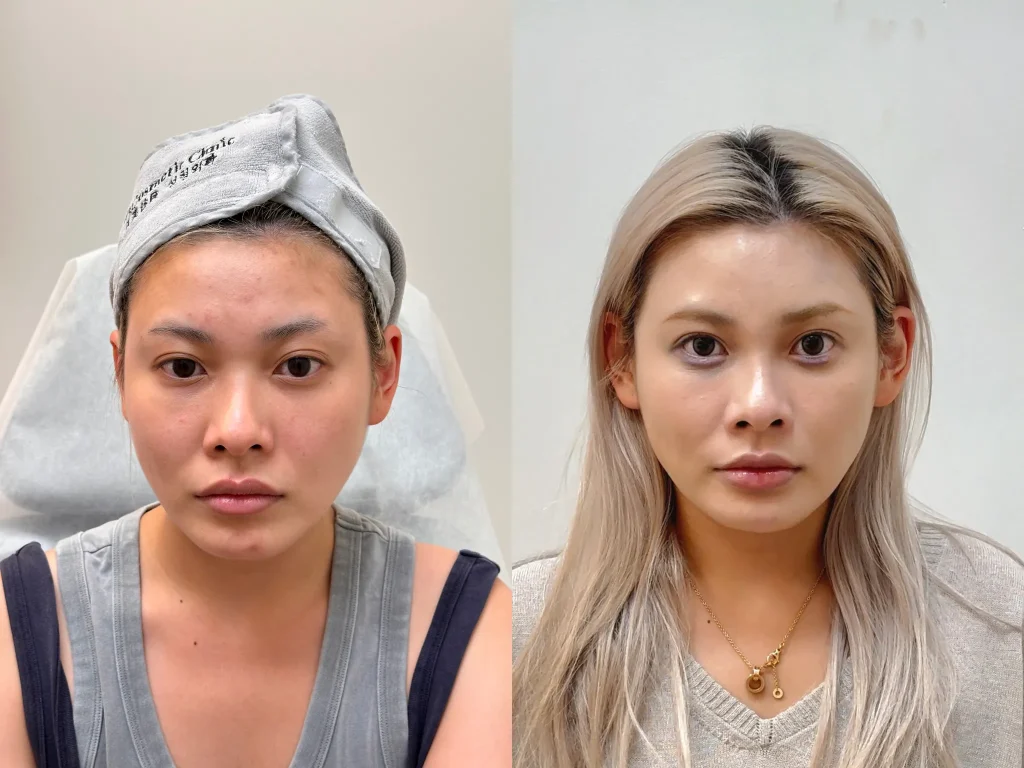 Hollow temples, Perioral injection, Hollow cheeks, Tear trough, thread double eyelids, Periorbital injection, before and after results, ID Cosmetic Clinic, Thermage Toronto, full face contour, eye worm, nose filler, chin filler