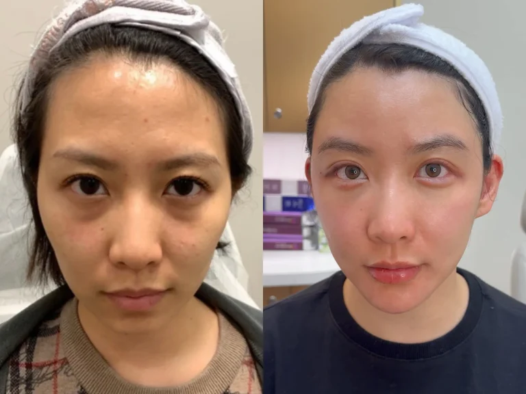 Perioral injection, Hollow cheeks, Tear trough, thread dounle eyelids, Periorbital injection, before and after results, ID Cosmetic Clinic, Thermage Toronto, full face contour, eye worm, nose filler, chin filler
