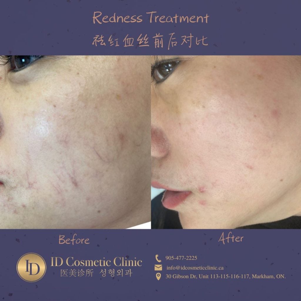 redness reomval Toronto