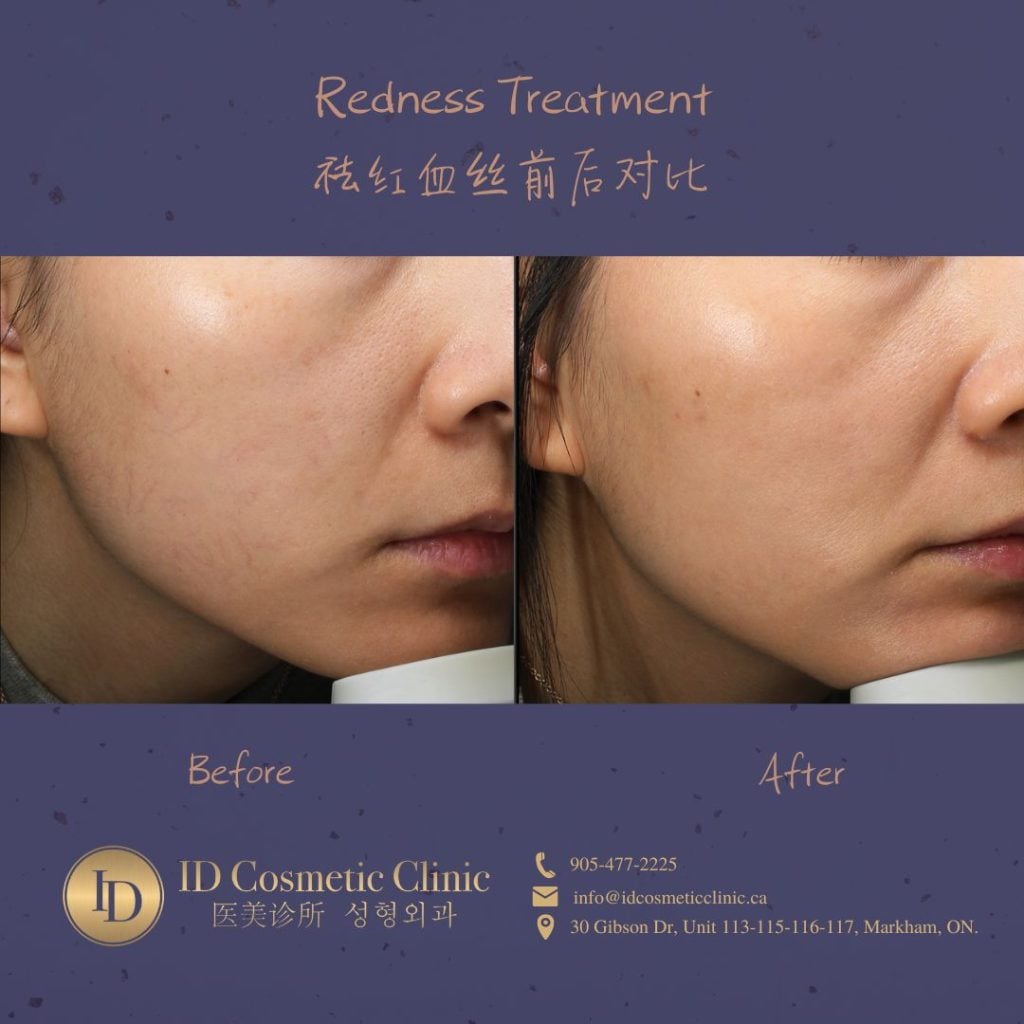 樱花镭射 多伦多 祛红 near me