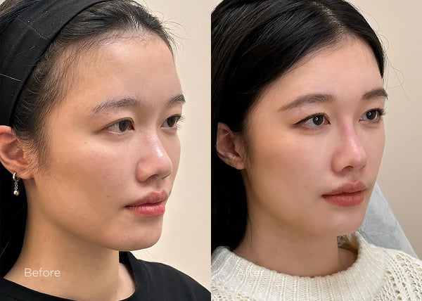 IPL photofacial before and after results showing reduced pigmentation and even skin tone