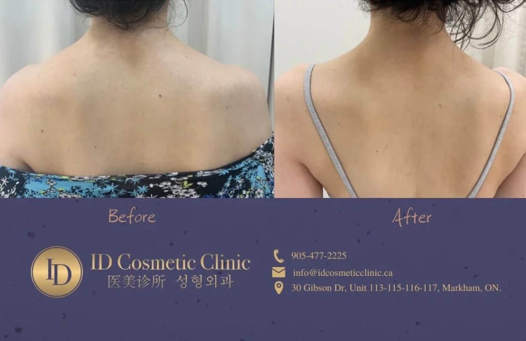 Toronto CoolSculpting Price Step by Step Guide by ID Cosmetic Clinic