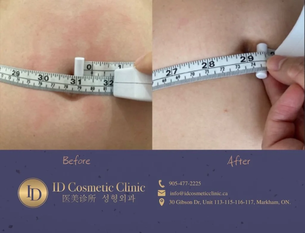 Toronto CoolSculpting contrast with Price ID Cosmetic Clinic