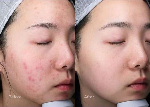 IPL photofacial before and after results showing reduced redness and improved skin clarity