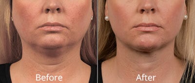 sylfirm glow toronto