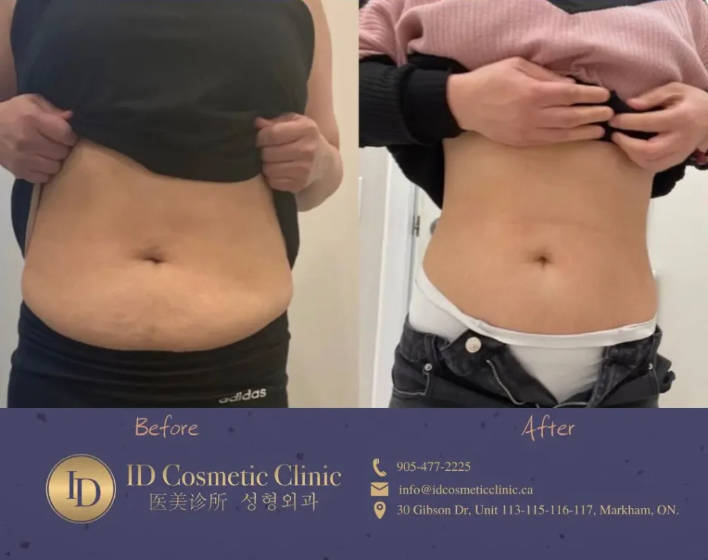 Toronto coolsculpting promotion at ID cosmetic Clinic for weight loss near me