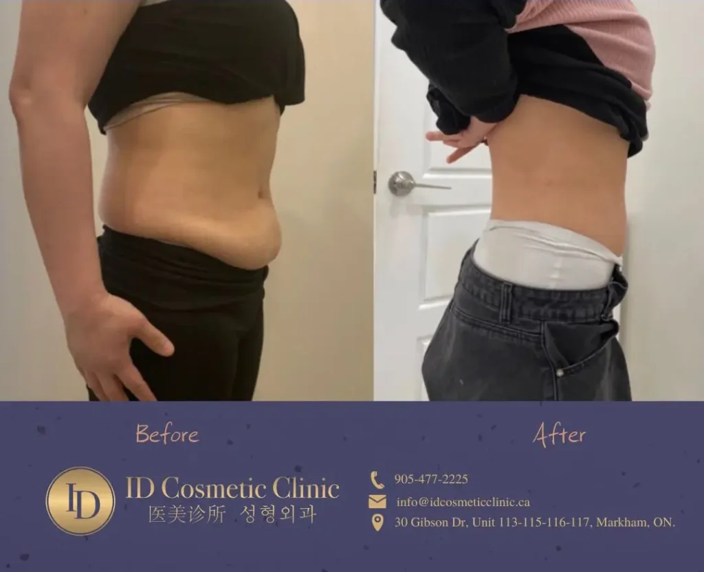 Toronto coolsculpting promotion at ID cosmetic Clinic for weight loss near me