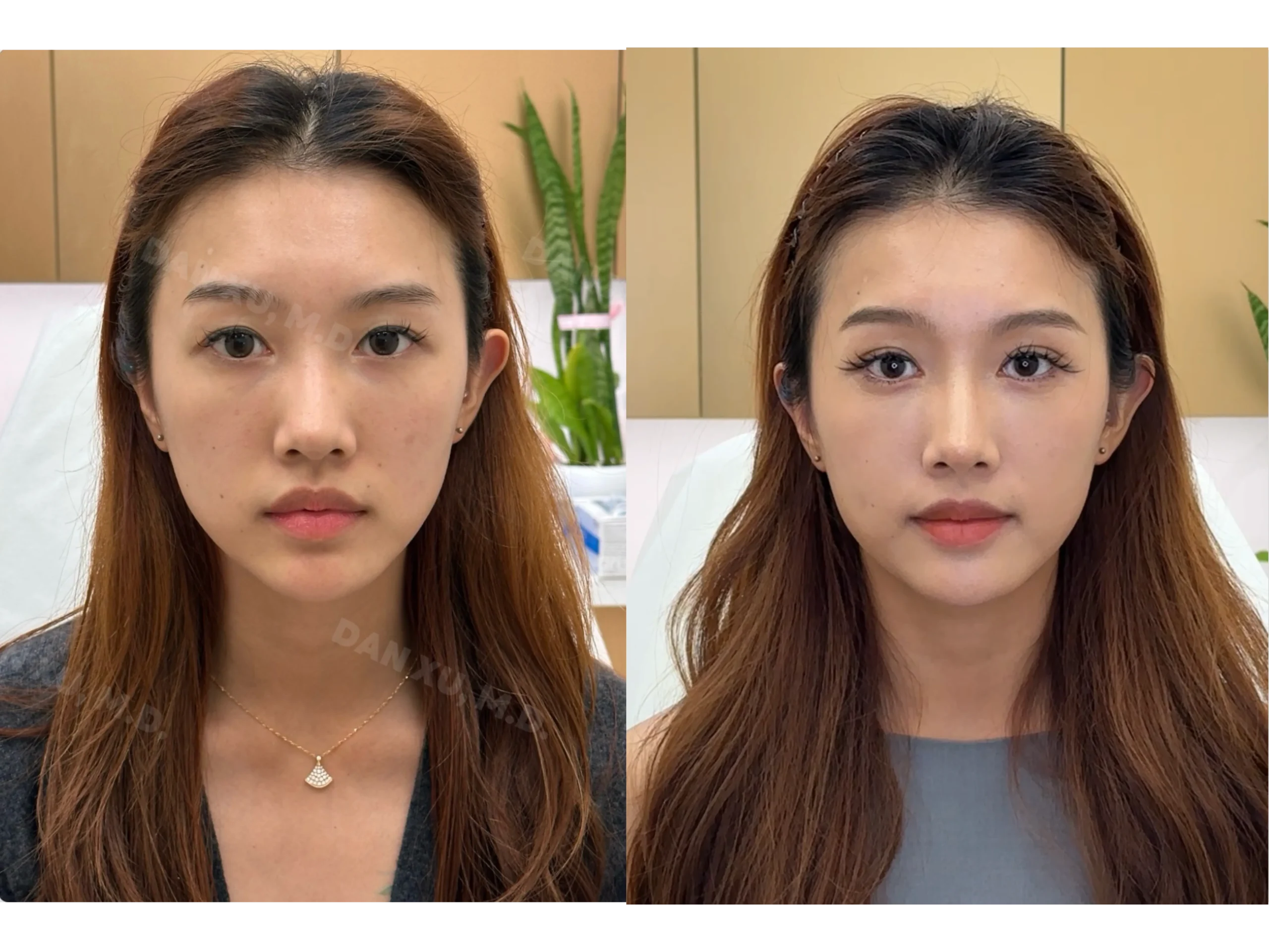 eye rejuvenation bright eye injection 4 scaled