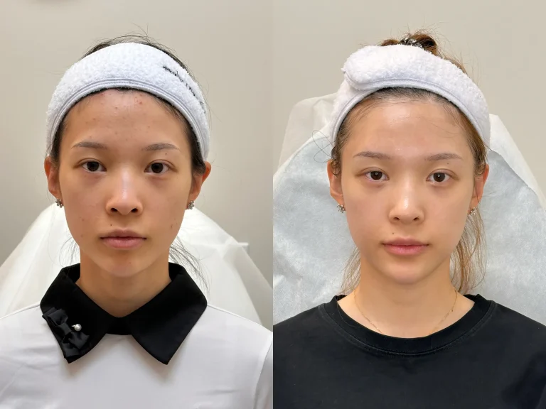 Hollow temples, Perioral injection, Hollow cheeks, Tear trough, thread double eyelids, Periorbital injection, before and after results, ID Cosmetic Clinic, Thermage Toronto, full face contour, eye worm, nose filler, chin filler