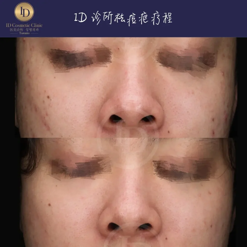 how to treat pimple scars naturally at ID Cosmetic Clinic