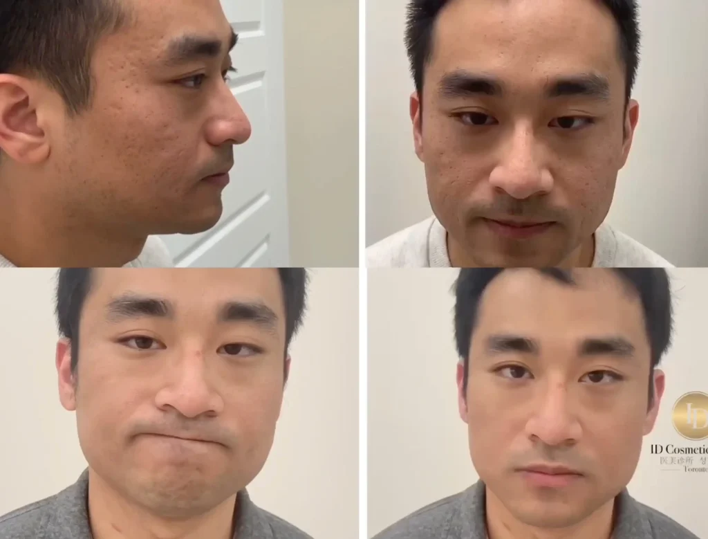 how to treat pimple scars naturally at ID Cosmetic Clinic