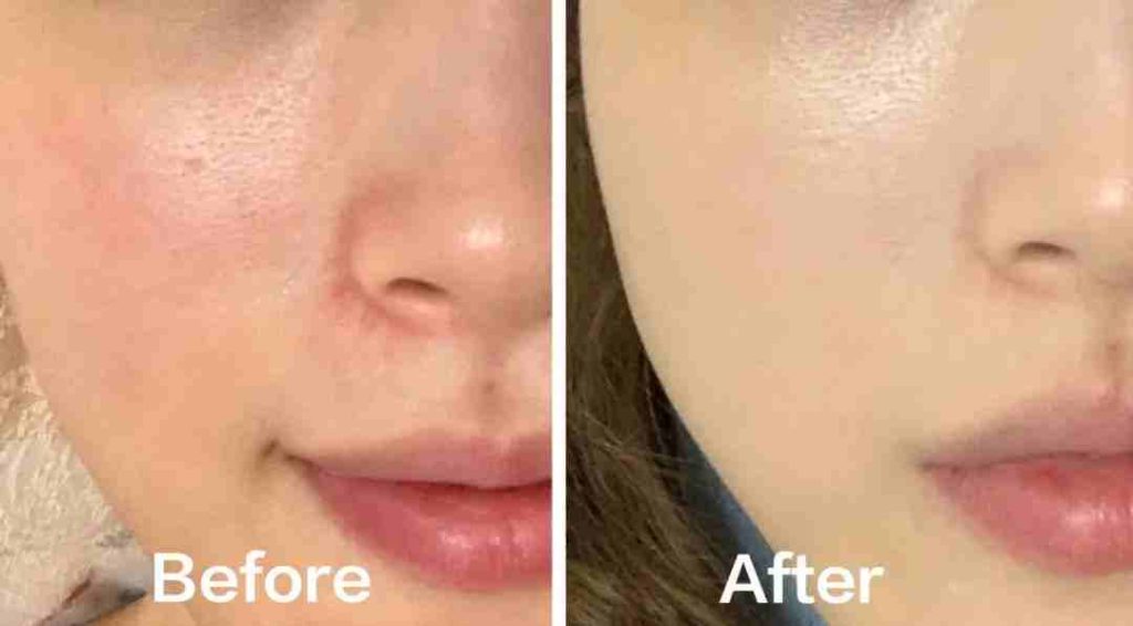 photorejuvenation lumeca ipl Toronto