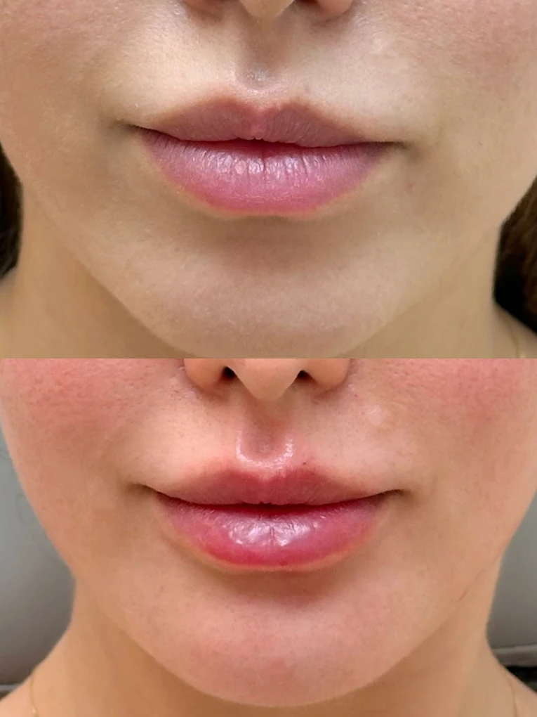lip fillers Markham lip fillers cost lip fillers injection HA lip dermal fillers