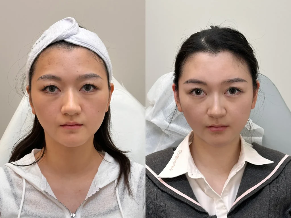 laser clinic markham, thread double eyelids, Periorbital injection, before and after results, ID Cosmetic Clinic, Thermage Toronto