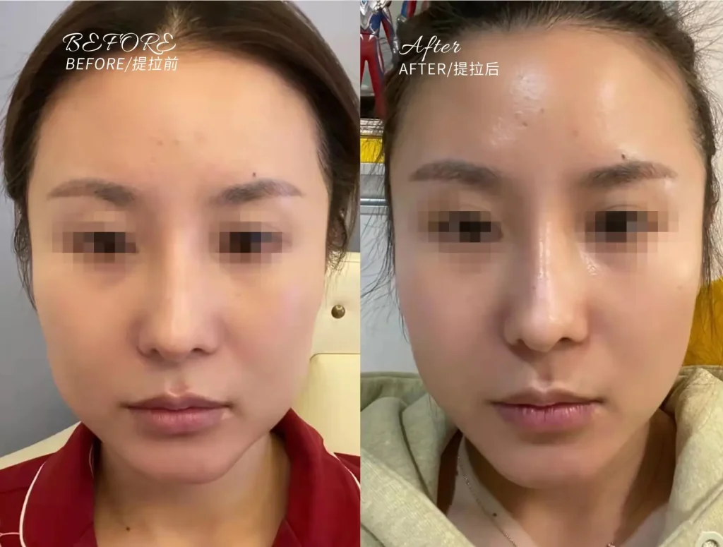 toronto thermage skin tightening
