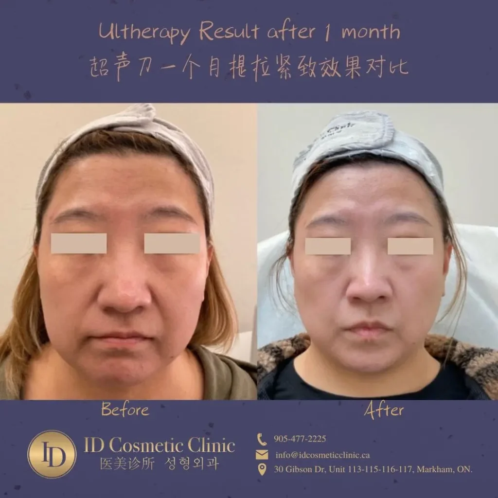 ultherapy toronto before and after at ID Cosmetic Clinic