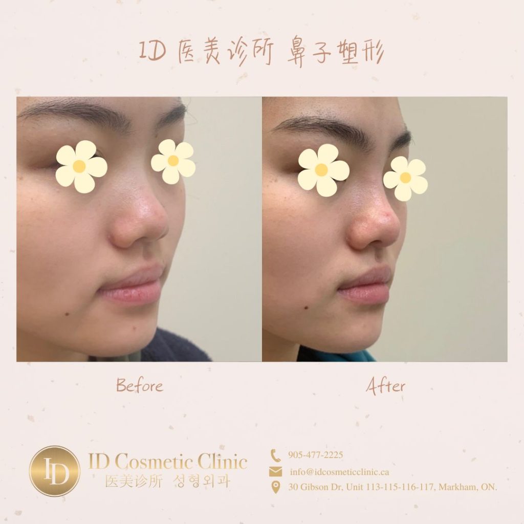 鼻子塑型 多伦多 Nose Filler Toronto