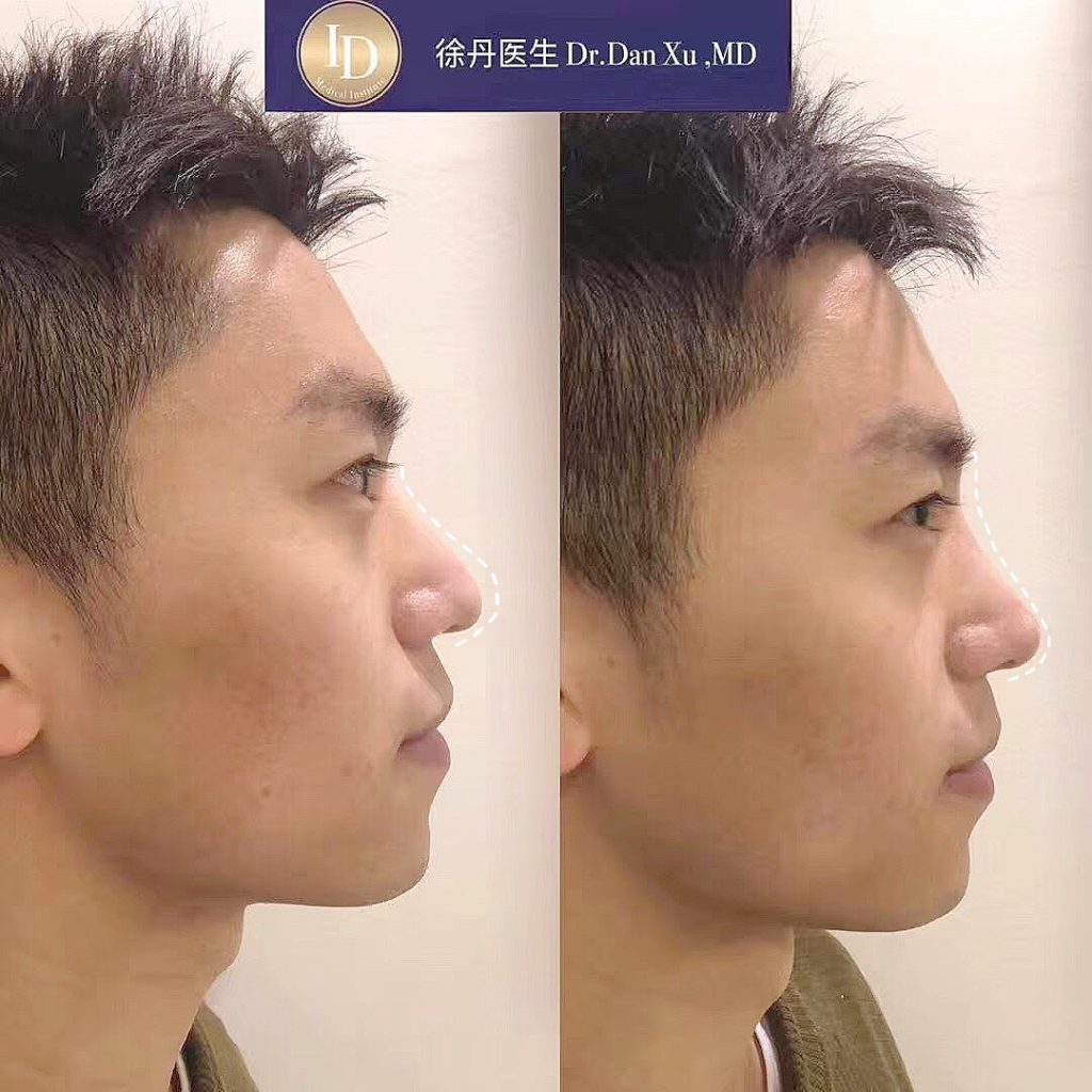 鼻子塑型 多伦多 Nose Filler Toronto