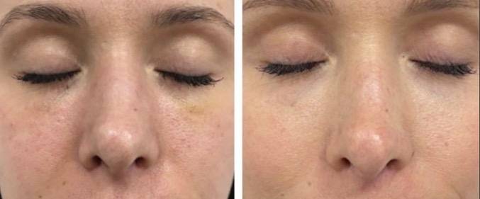what is mesotherapy