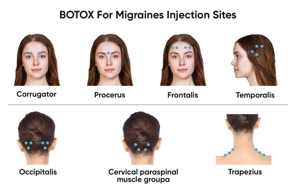 botox migraine treatmen toronto