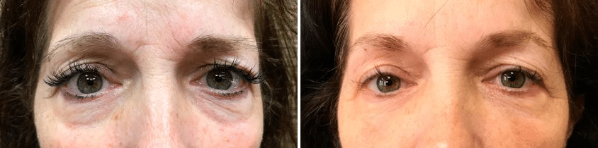 eye cosmetic treatment Toronto