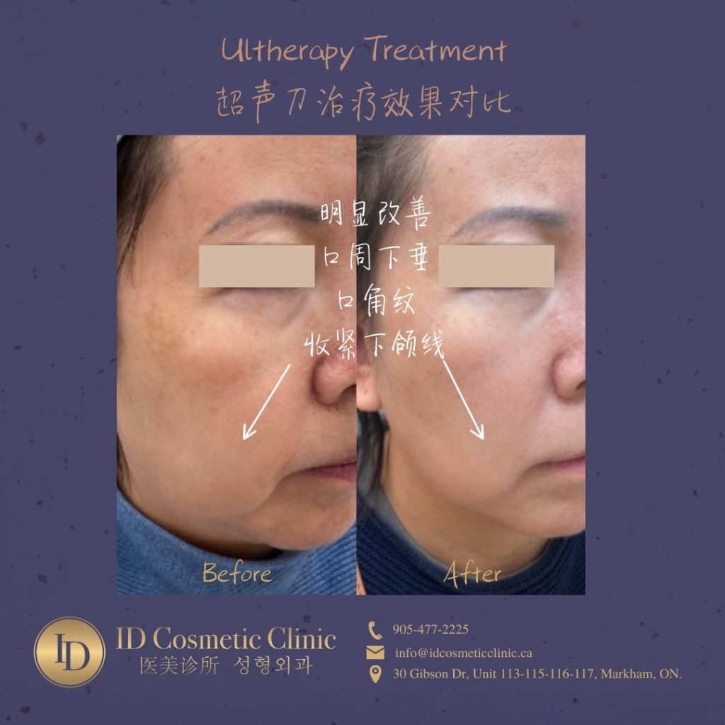does ultherapy work
