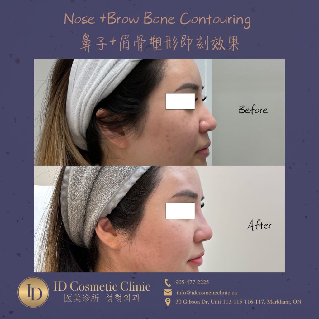 鼻子塑型 多伦多 Nose Filler Toronto
